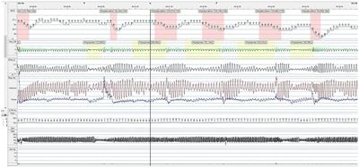 Sleep and sleep-related breathing disorders in patients with spinal muscular atrophy: a changing perspective from novel treatments?